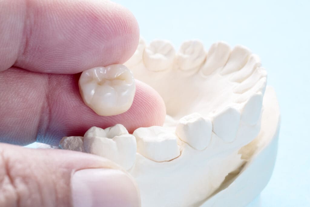 Dental Crown in Edmonton AB