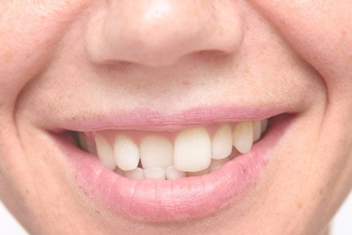 Crooked Teeth in Edmonton AB