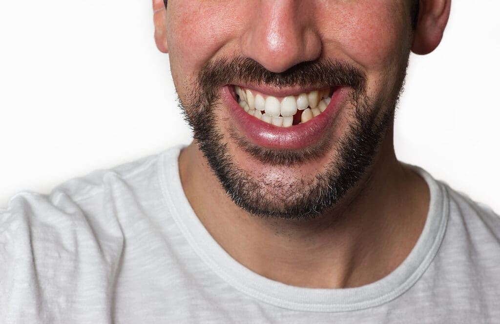 Missing Teeth in Edmonton AB