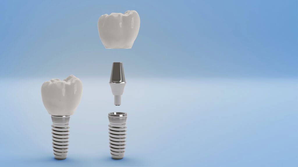 Dental Implant Edmonton AB