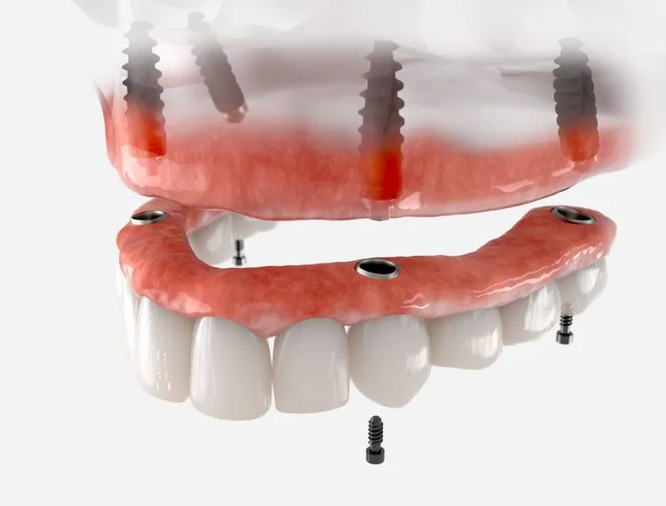 Dentures vs. Implants: How to Choose in Edmonton, AB